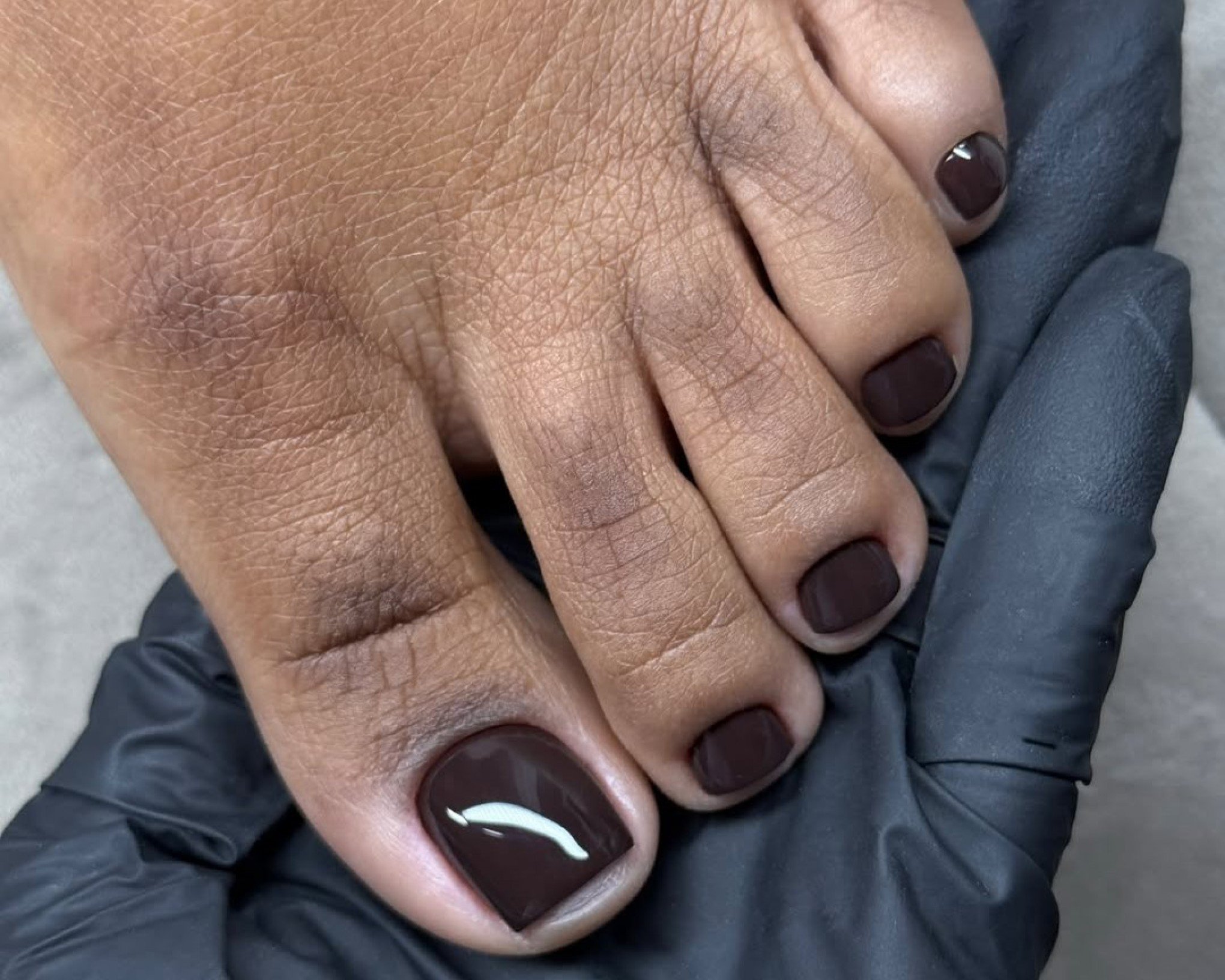 Melanoníquia: quando uma linha escura na unha é preocupante?