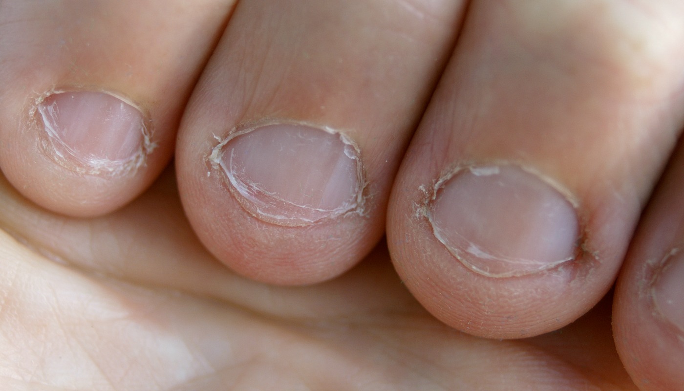 Problemas de Saúde nas Unhas: Identifique e Trate a Onicomicose