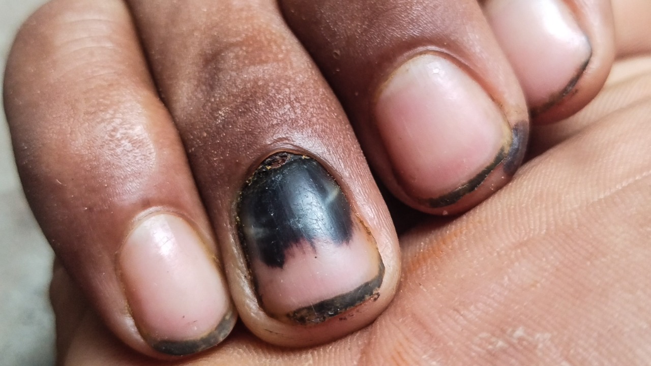 unha preta por fungo