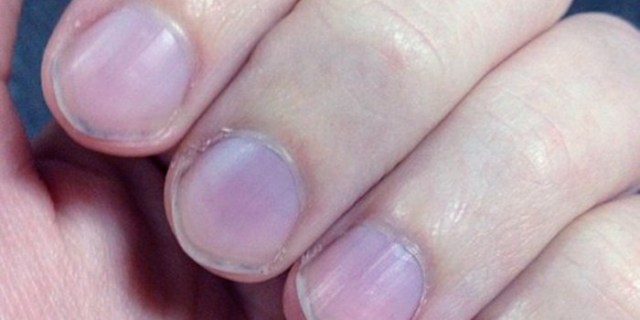 unha roxa após pancada