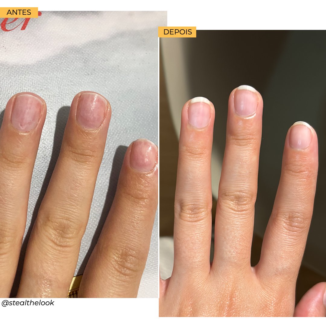 Quando a unha fraca é um sinal de alerta médico?