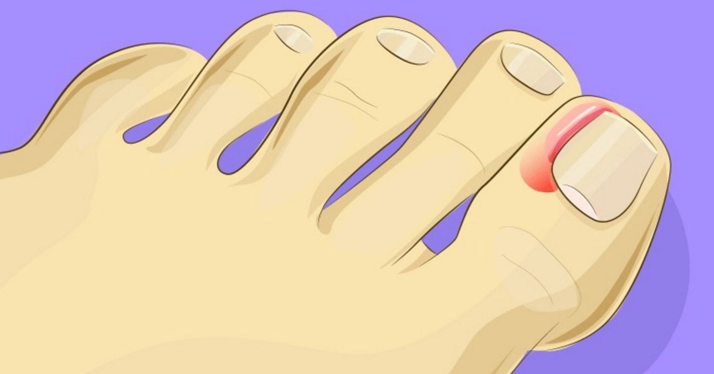 Paroníquia: Entenda as Causas e os Sintomas da Inflamação na Unha