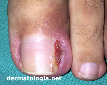 Paroníquia: Entenda as Causas e os Sintomas da Inflamação na Unha