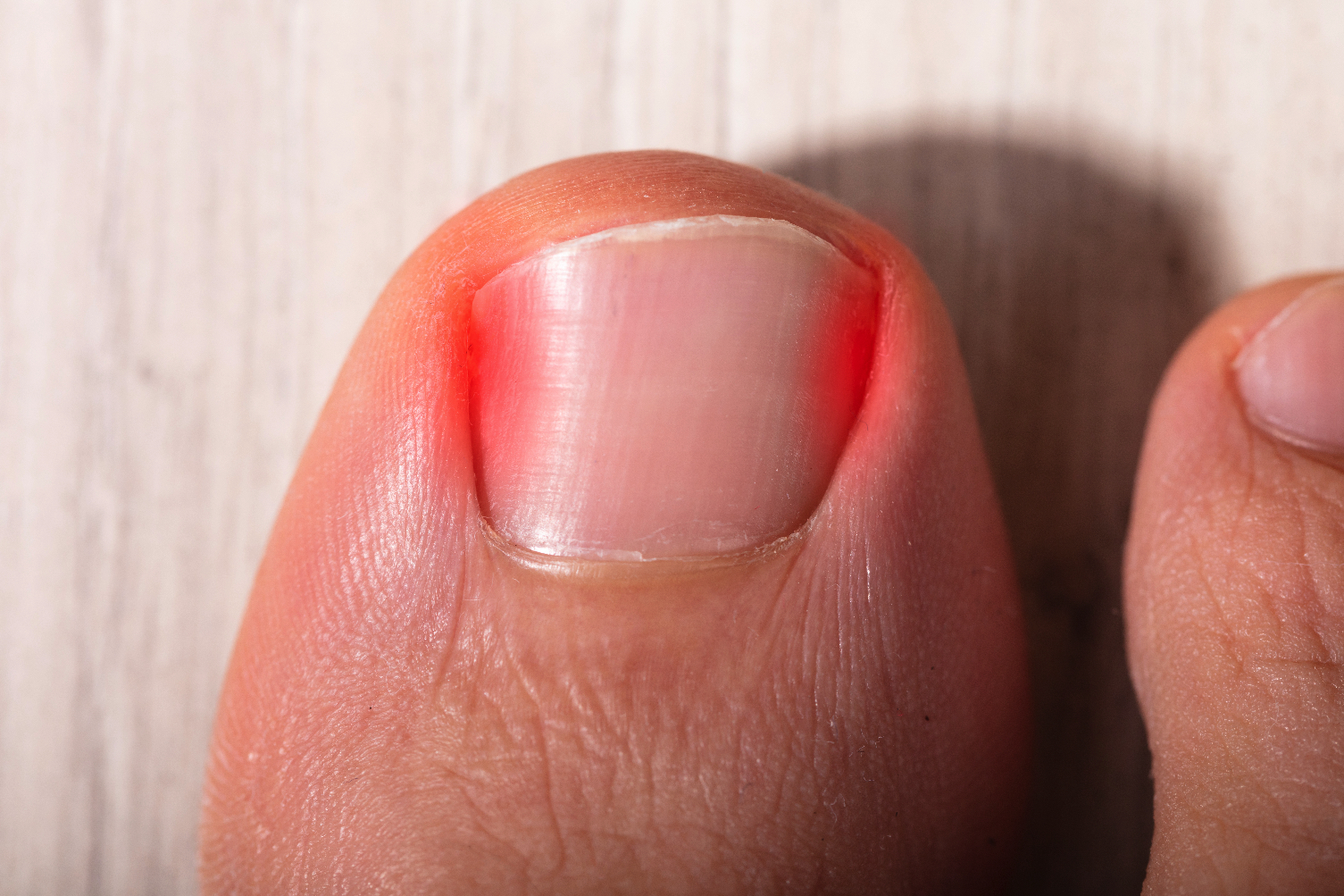 Guia Completo: Como Prevenir Unha Encravada e Inflamada