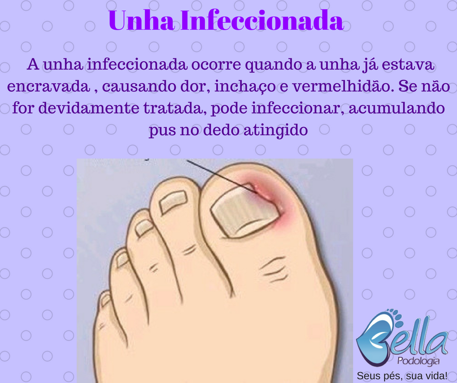 Paroníquia: Entenda as Causas e os Sintomas da Inflamação na Unha