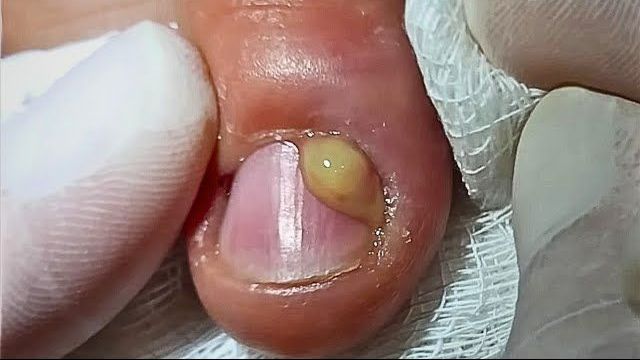 unha inflamada com pus