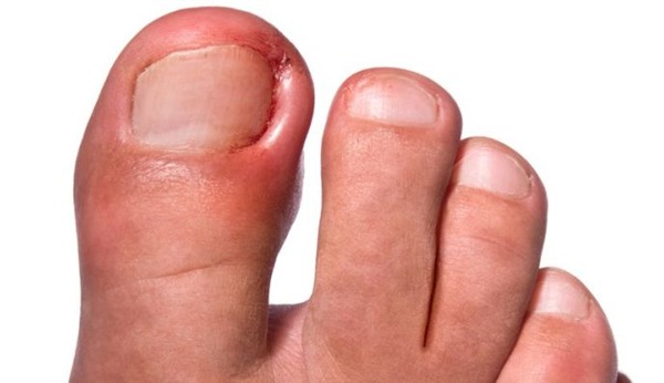 unha inflamada com pus