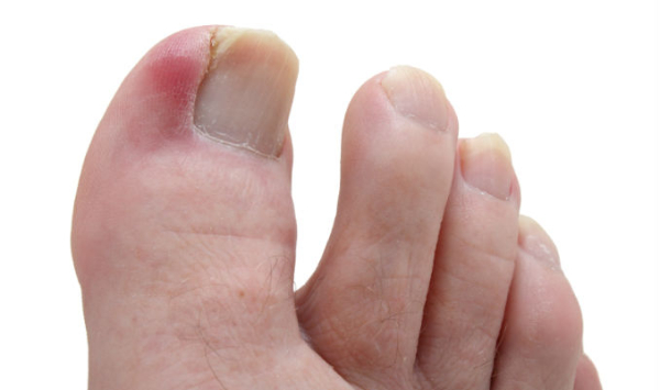 unha inflamada vs unha infeccionada qual a diferença