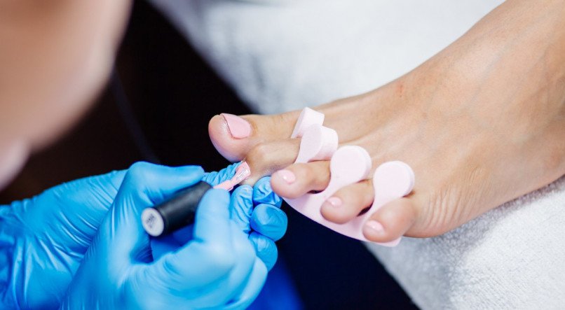 Como identificar e tratar a paroníquia aguda