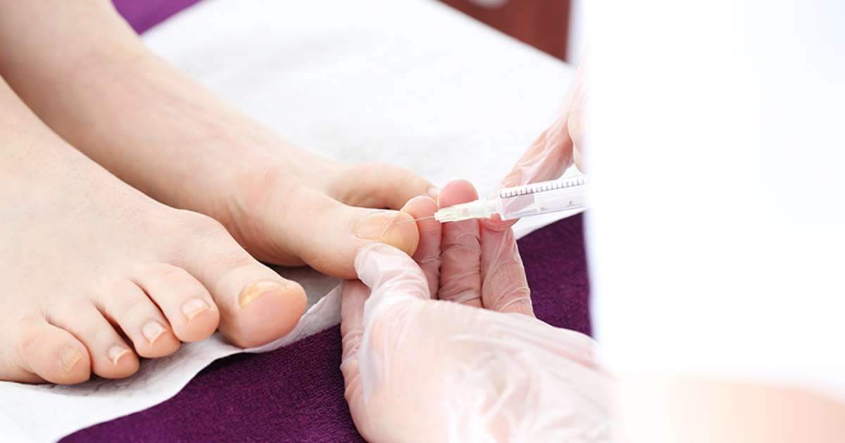 A eficácia do bicarbonato de sódio no tratamento de unhas inflamadas