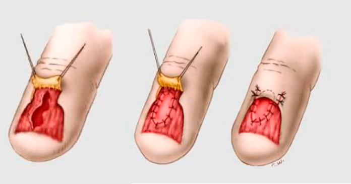 unha machucada por pancada o que fazer