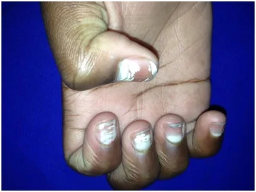 7 dicas para ter unhas saudáveis e sem manchas brancas