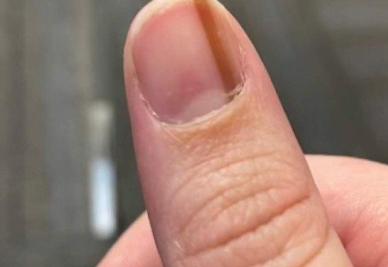 fotos de unha melanoma benigno