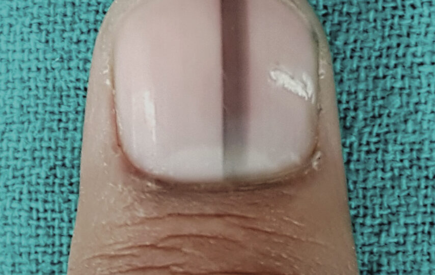 o que causa mancha escura na unha benigna