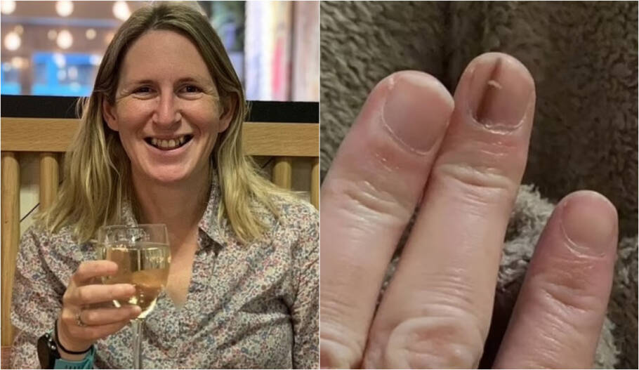 melanoma subungueal em polegar