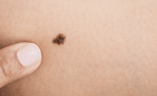 custo biópsia unha melanoma