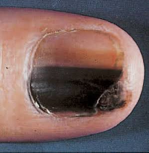 unha melanoma benigno fotos