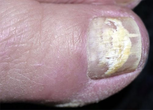 Unha Oca: Quando Procurar um Dermatologista ou Podólogo?