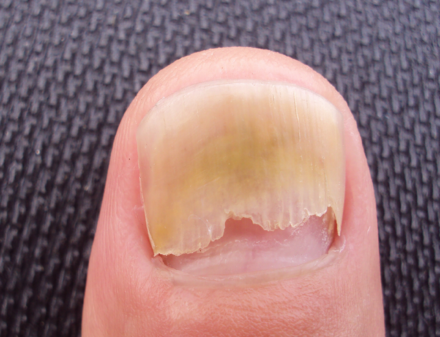 Micose de Unha: O Guia Completo para Identificar e Tratar a Onicomicose