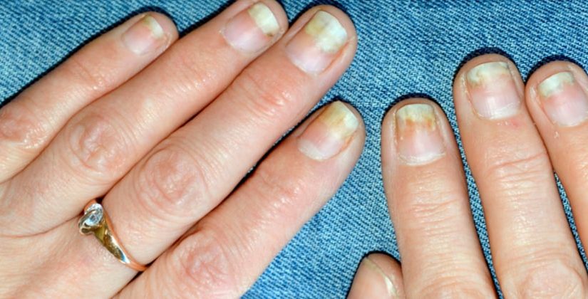 Micose de Unha: O Guia Completo para Identificar e Tratar a Onicomicose