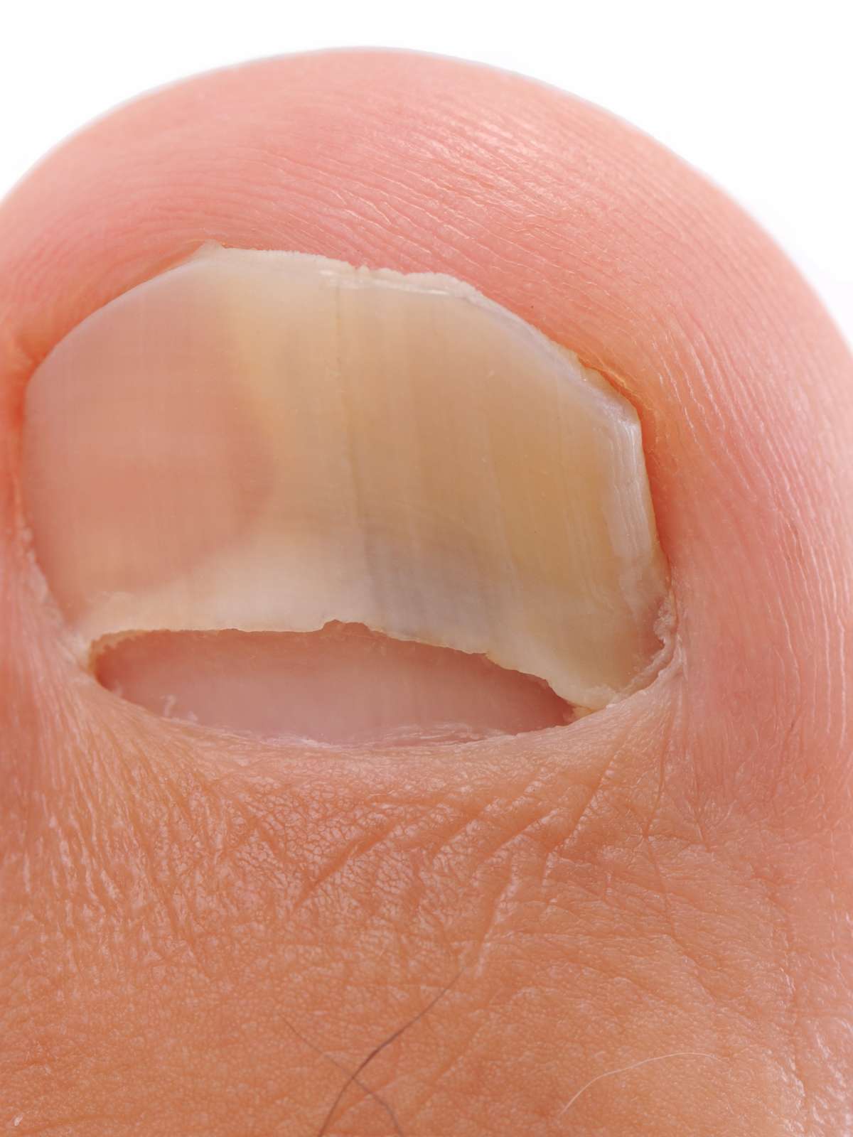 Como Prevenir e Cuidar de Unhas Ocas: Dicas de Higiene e Produtos