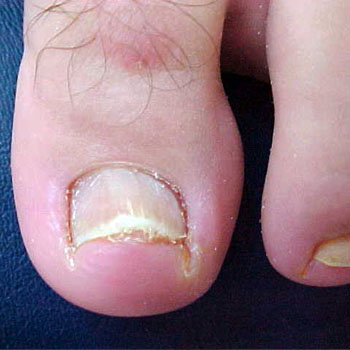 como identificar onicólise nas unhas dos pés
