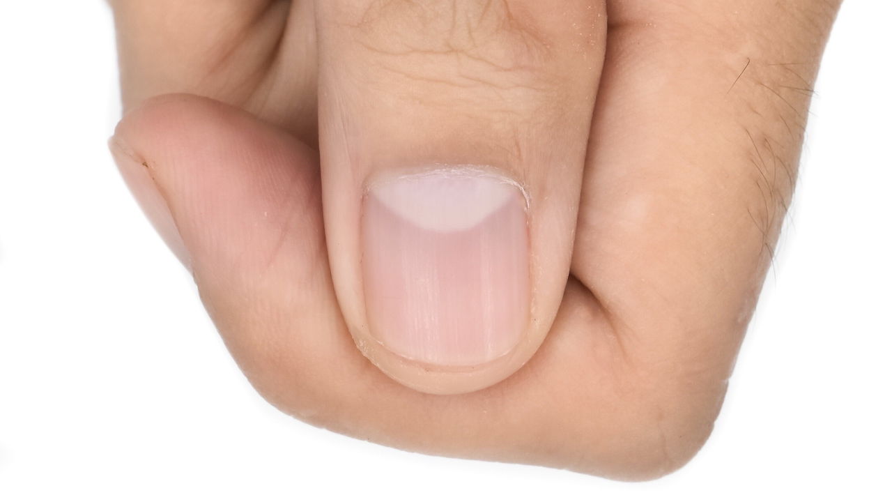 causas de unhas onduladas