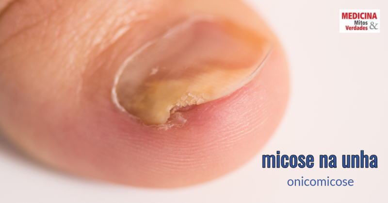 tratamento para unhas onduladas