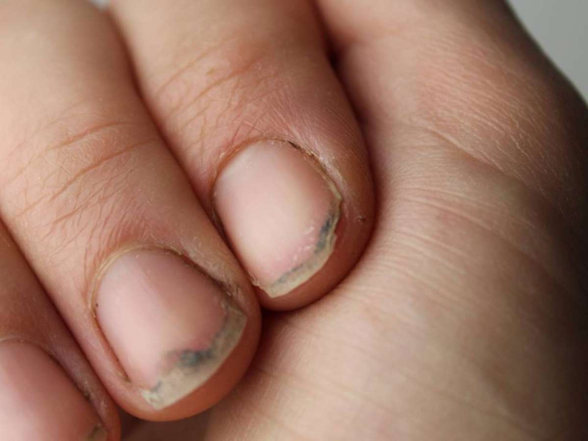 unhas onduladas e fracas