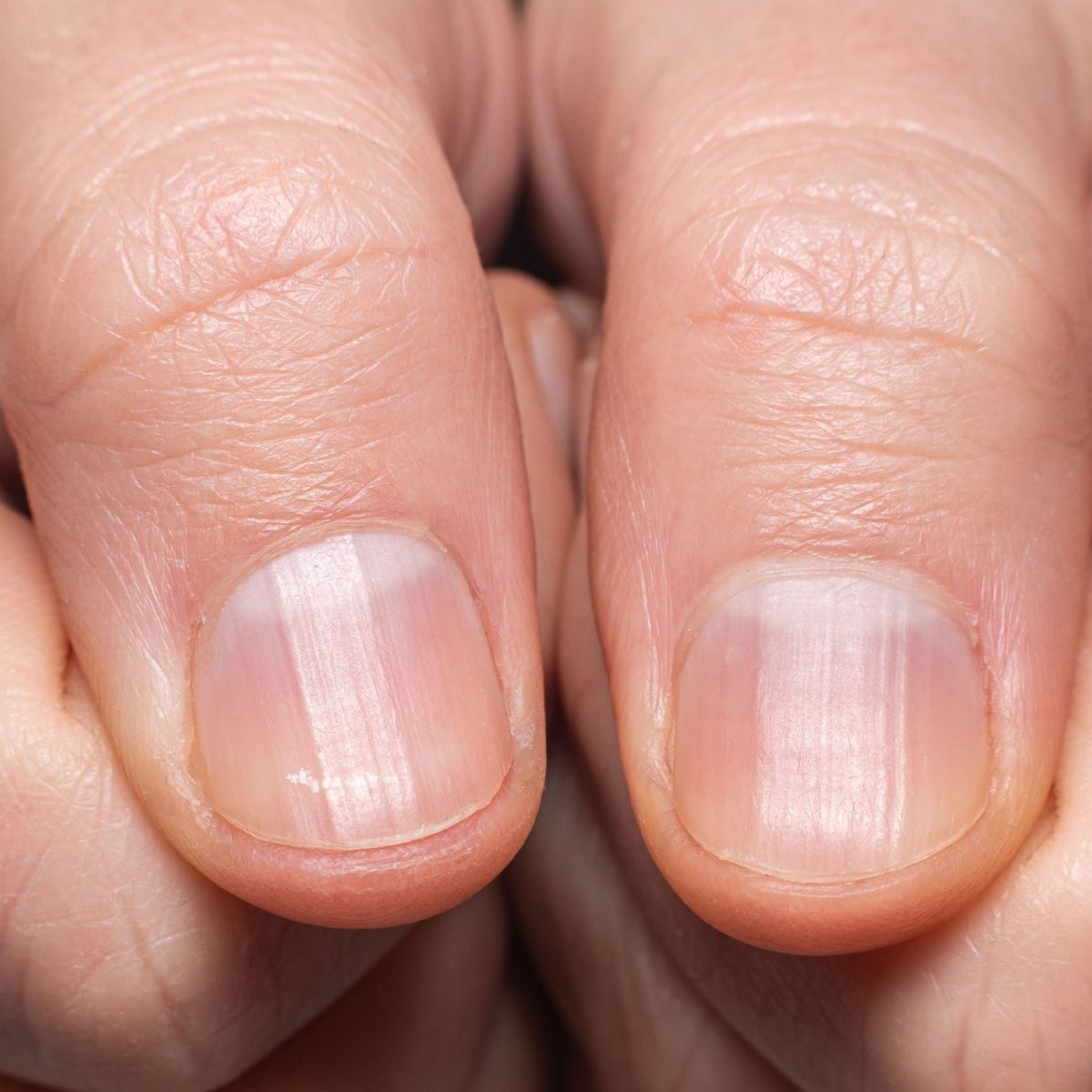 unhas onduladas e quebradiças