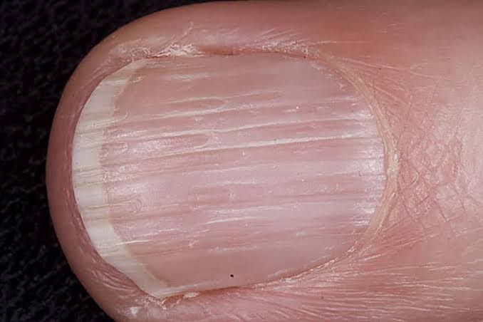 unhas com estrias verticais
