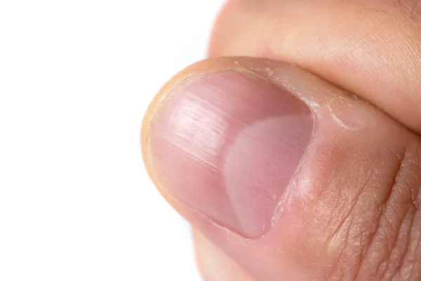 melanoma ungueal