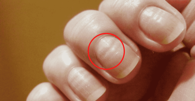 unhas envelhecidas