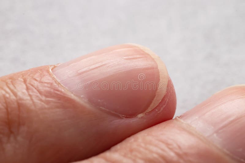 unhas com linhas verticais