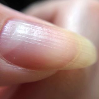 unhas e deficiência de vitaminas