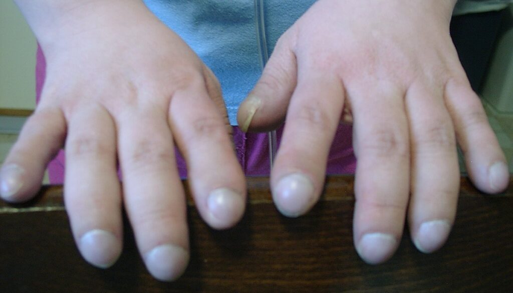 unhas e anemia