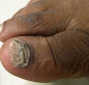 Prevenção da Unha Preta: 5 Hábitos Essenciais