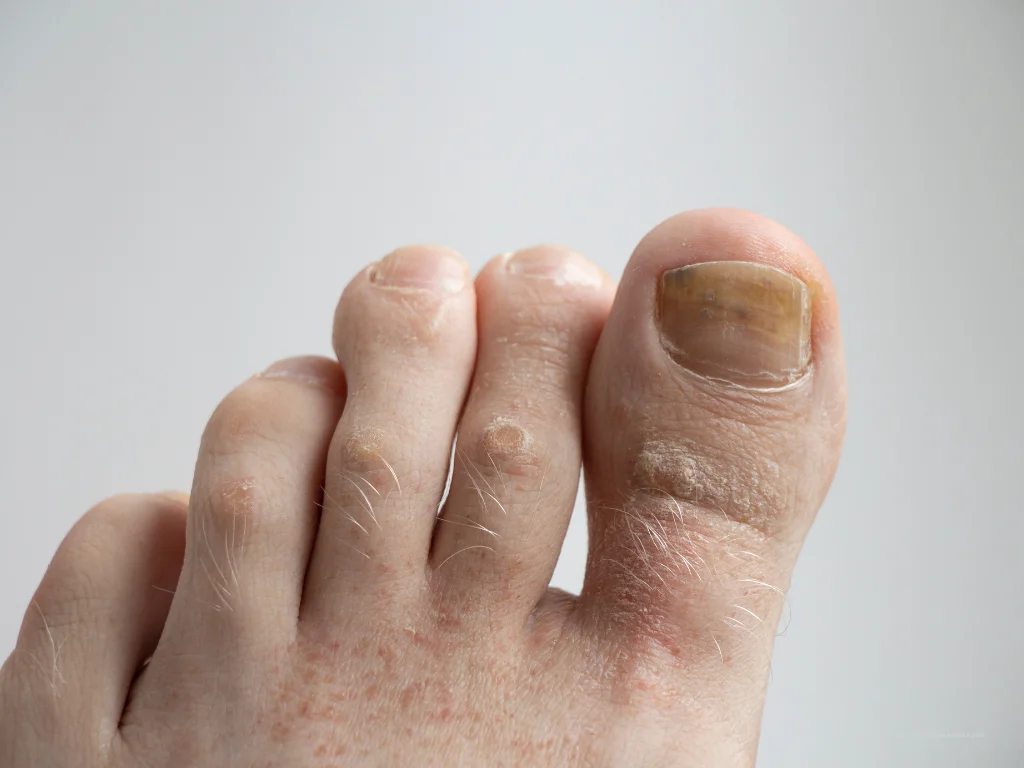 Procedimentos Avançados para Tratar Fungos na Unha: Laser e Fresagem