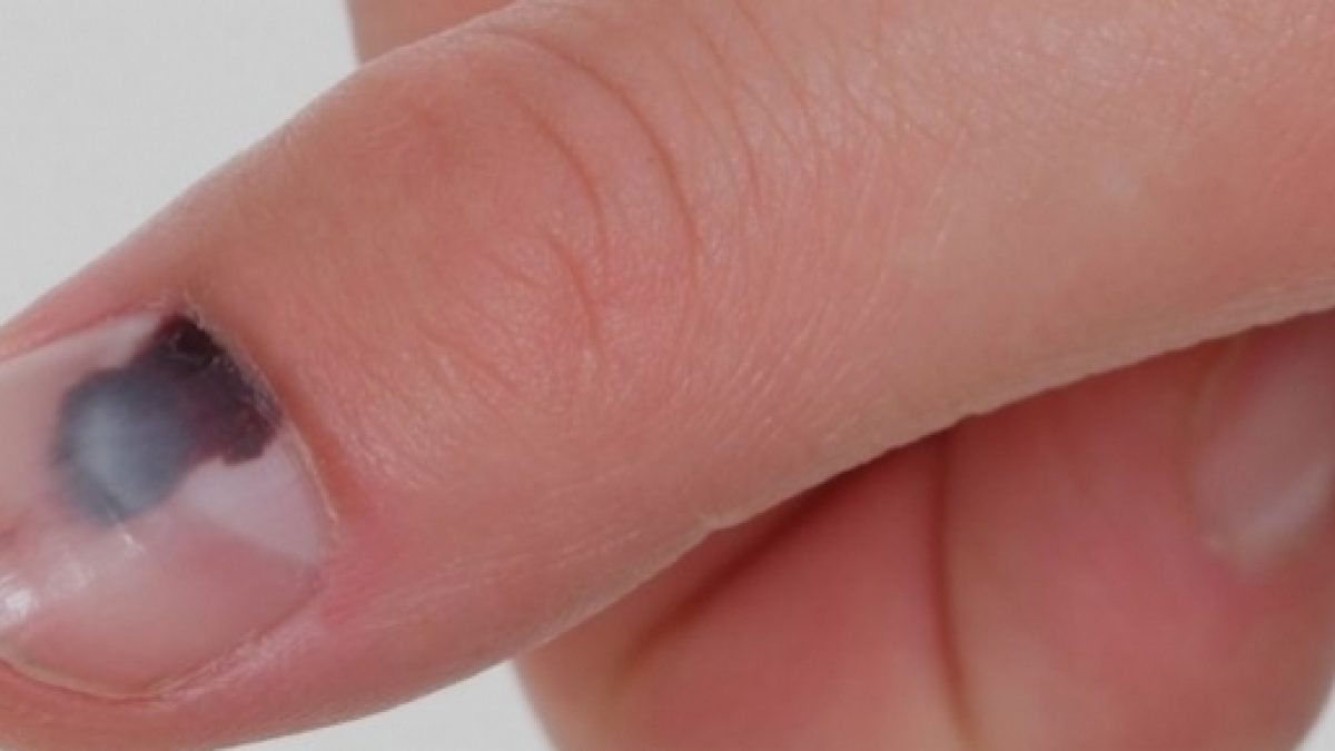 Diferenças entre Unha Preta por Micose e Trauma