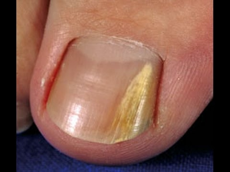 Guia Completo: Como Consertar Unha Quebrada em Casa com Materiais Simples