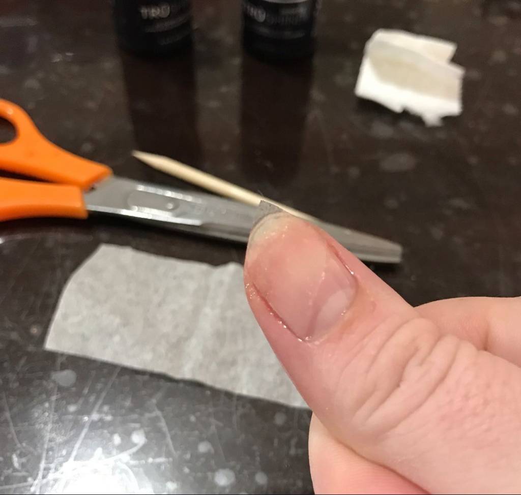 Unha Quebrou na Carne? Saiba o Que Fazer para Evitar Infecções