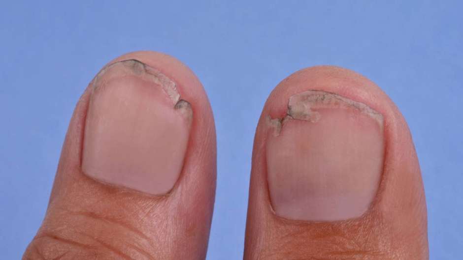 Métodos Caseiros para Reparar Unhas Trincadas: Saquinho de Chá, Algodão e Mais