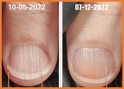 unha rachada no meio