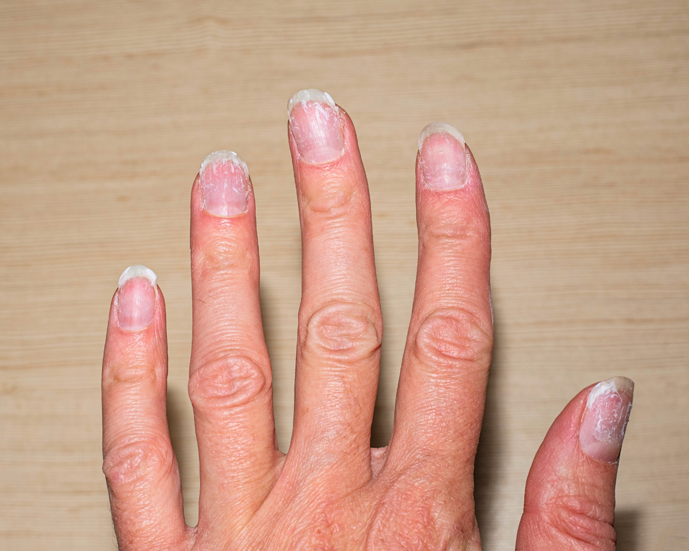unhas secas e quebradiças