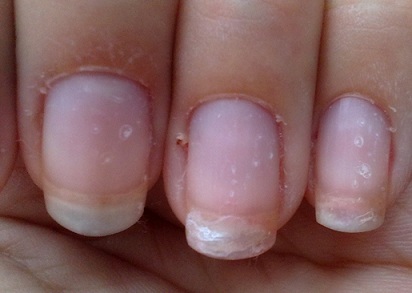 unhas secas e quebradiças