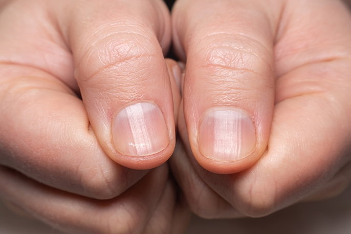 unhas secas e quebradiças
