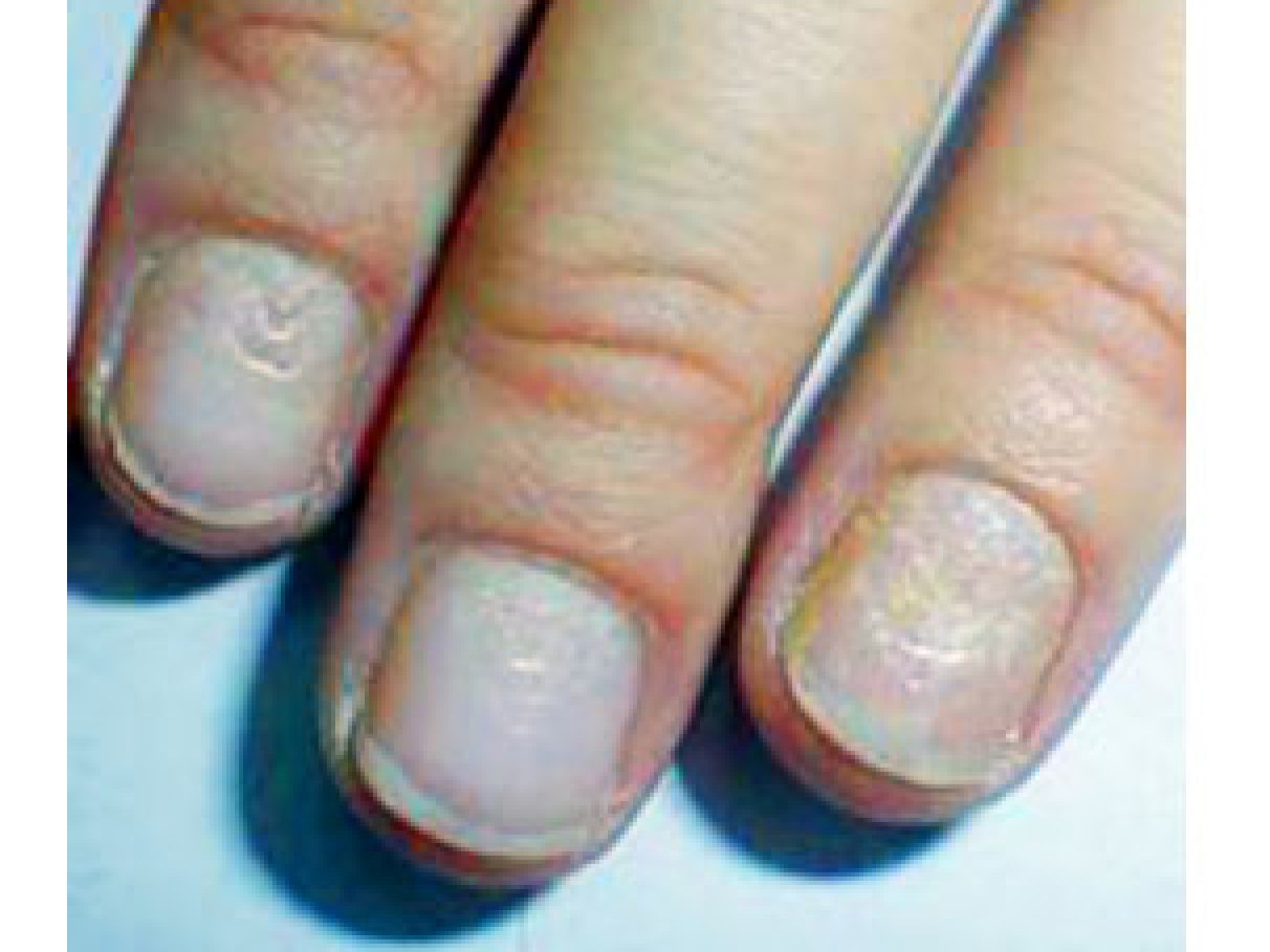 tratamento para unhas opacas