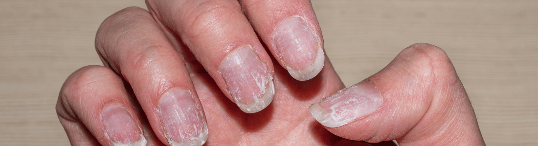 unhas descamando o que fazer