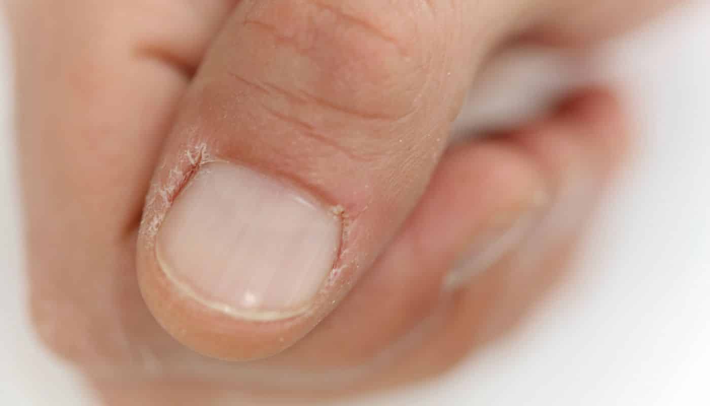 unhas ressecadas por falta de vitamina