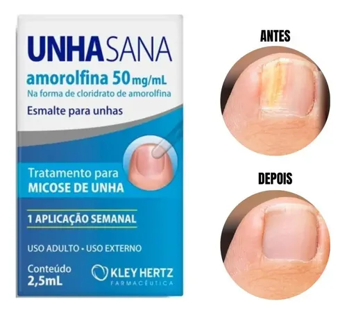 Unha Sana vs. Outros Tratamentos para Micose de Unha: Qual o Melhor?